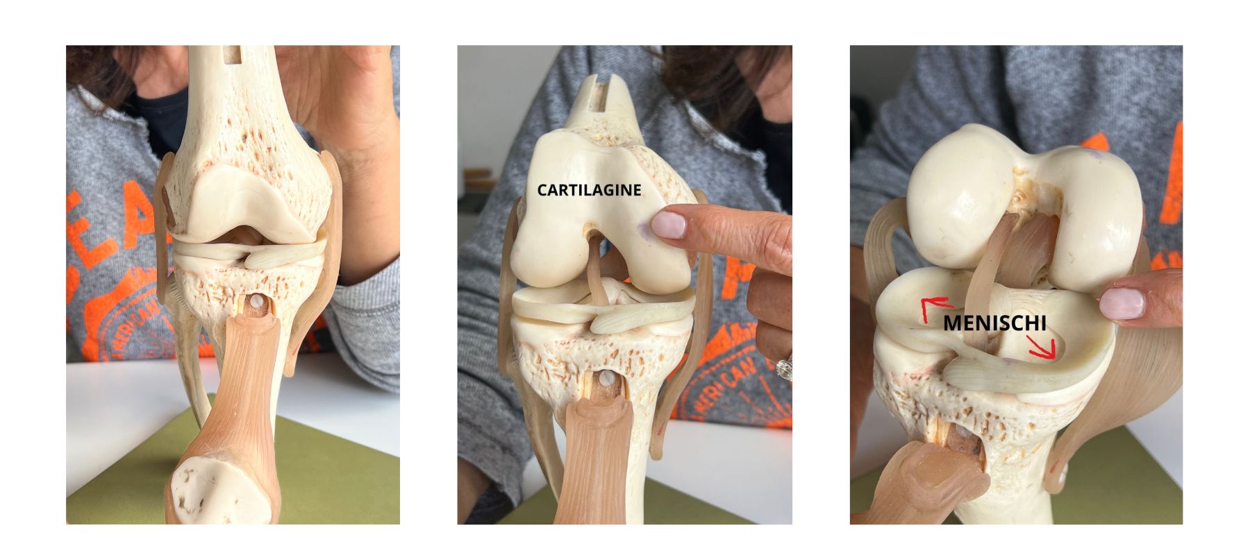 artrosi ginocchio modellino con cartilagine e menischi