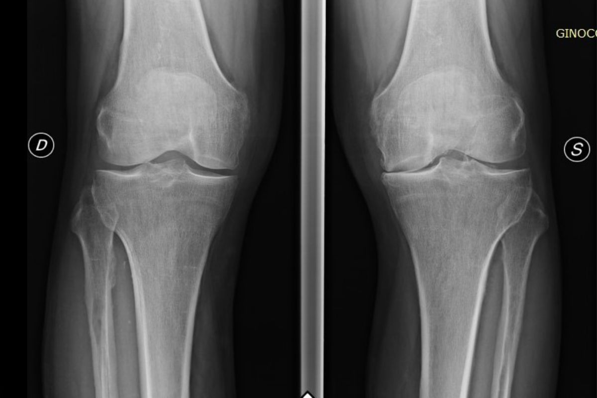 artrosi ginocchio radiografia ginocchio destro e sinistro
