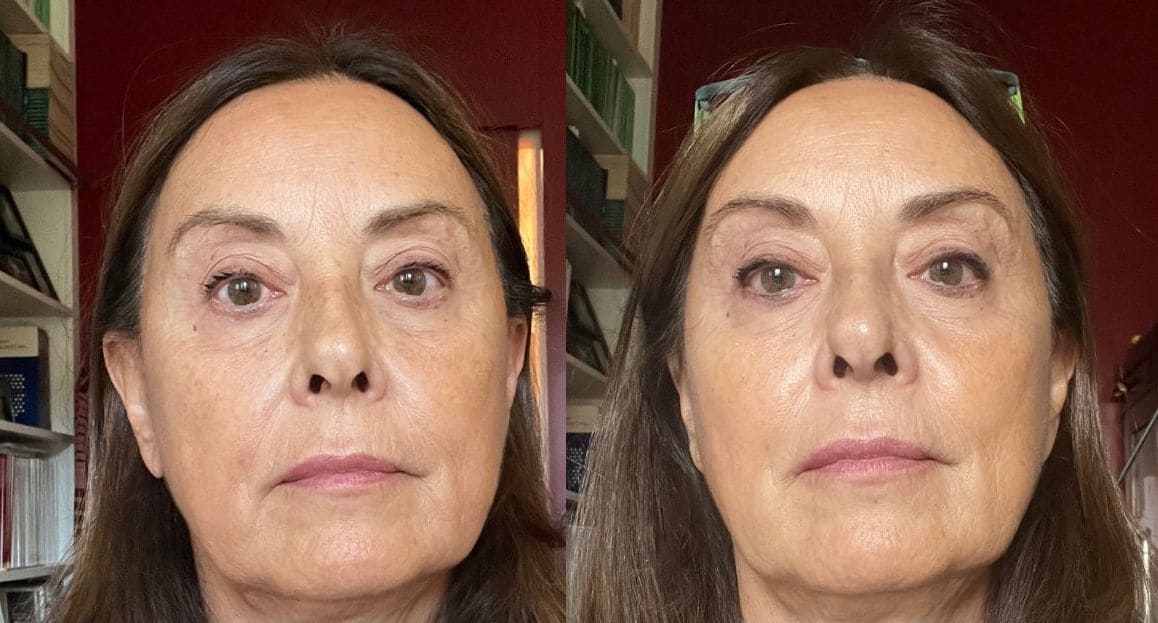 DermRays Revive: il laser viso da fare a casa che cambierà la tua pelle 4 laser viso dermrays revive la mia esperienza foto prima dopo