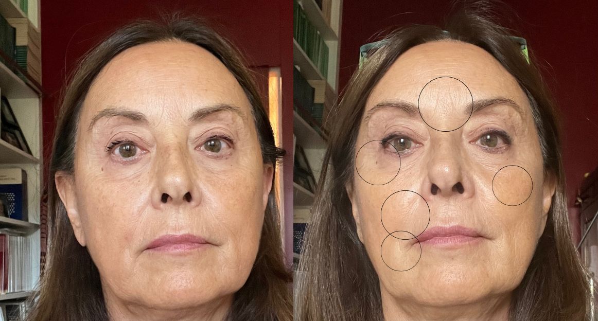 DermRays Revive: il laser viso da fare a casa che cambierà la tua pelle 5 laser viso dermrays revive risultati dopo 4 settimane